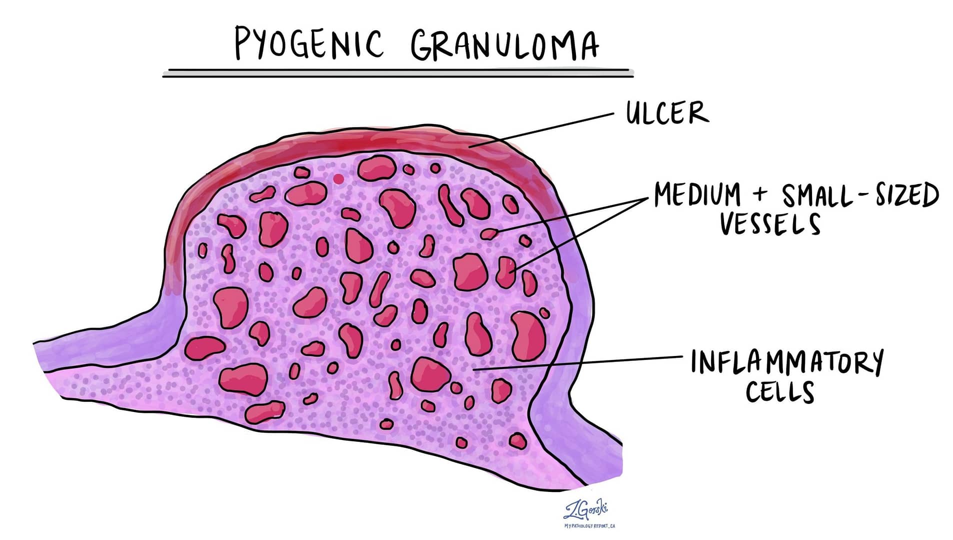 pyogenic granuloma