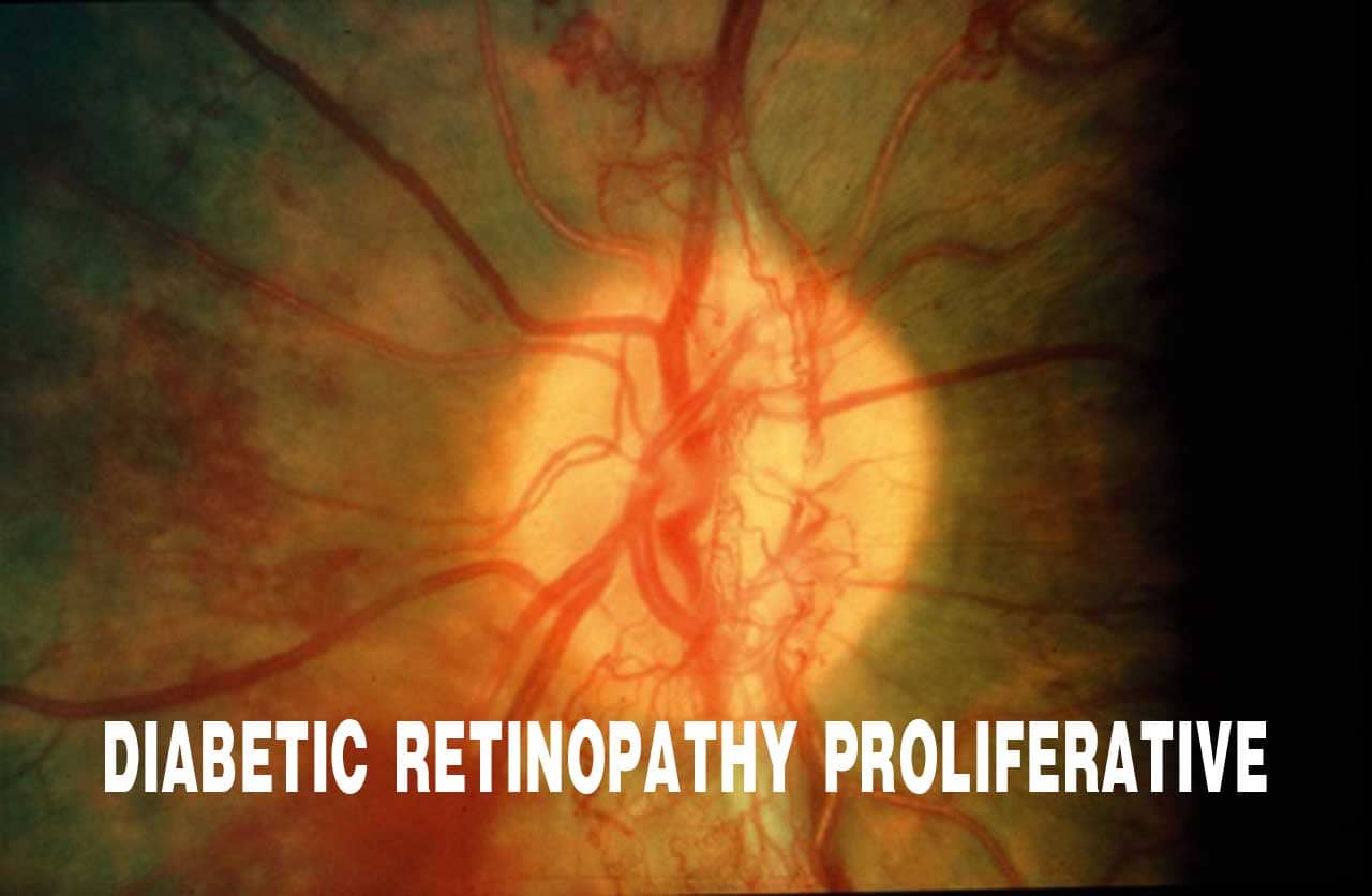 Diabetic Retinopathy Proliferative