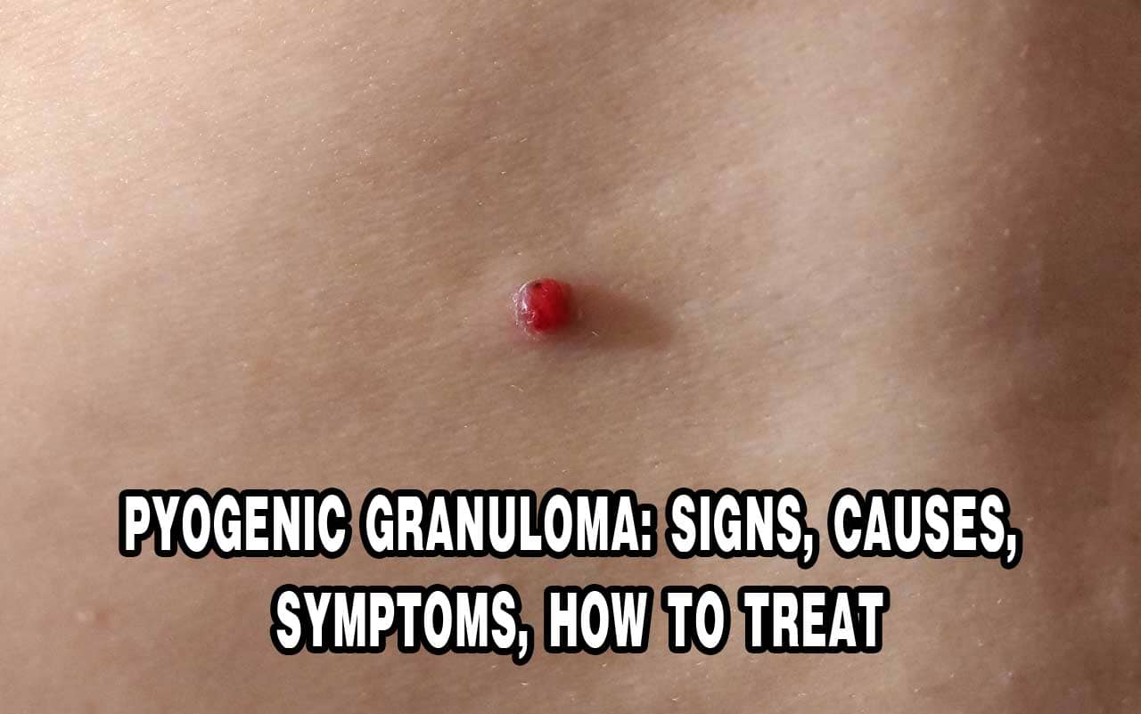 Treatment and Causes of Pyogenic Granuloma